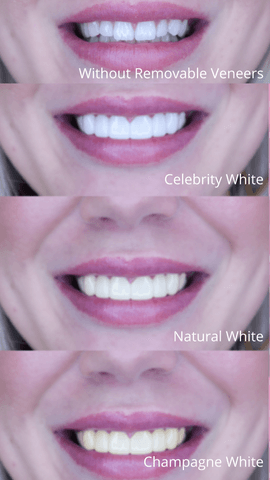 What's the Right Shade for My Clip On Veneers? - removable-veneers