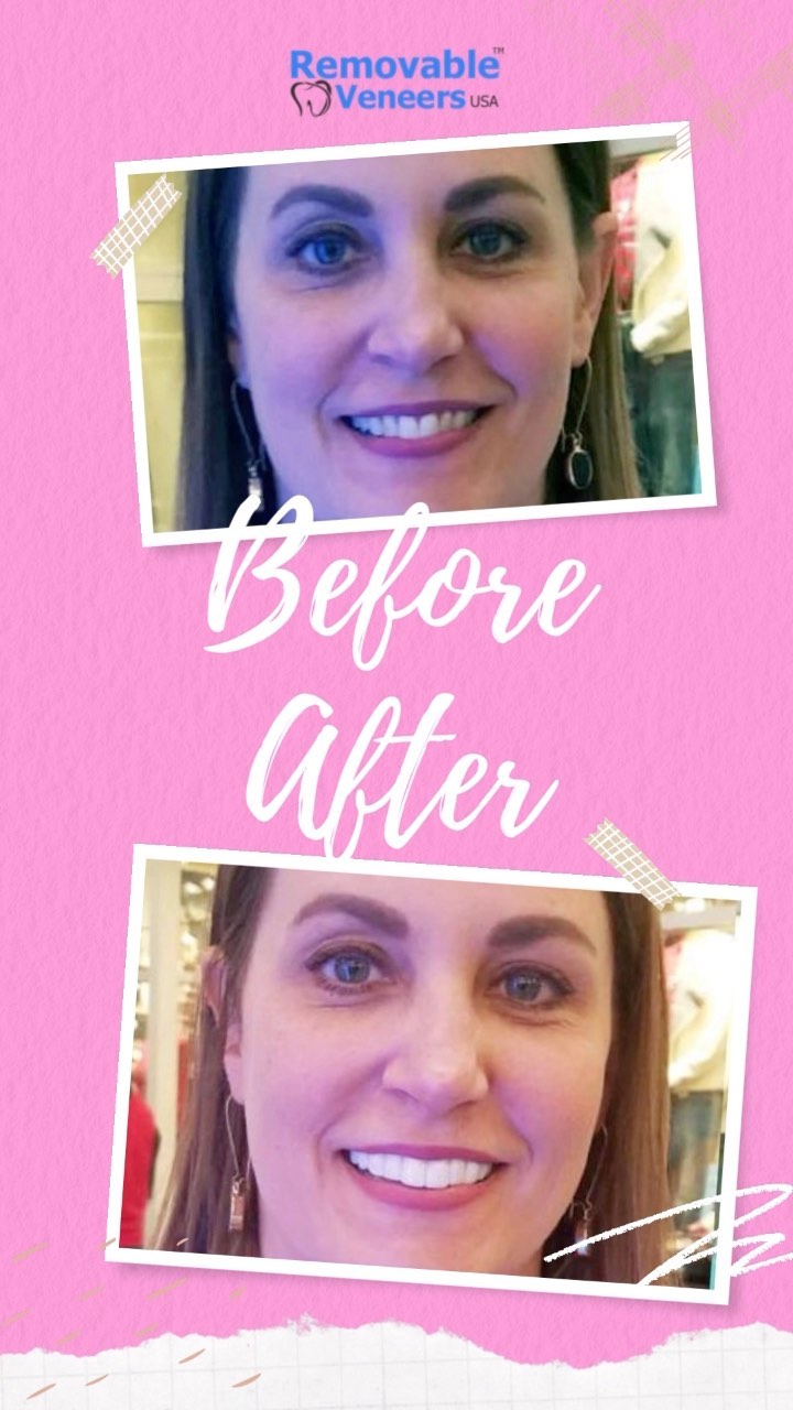 The 7 Super Powers of your Smile - removable-veneers