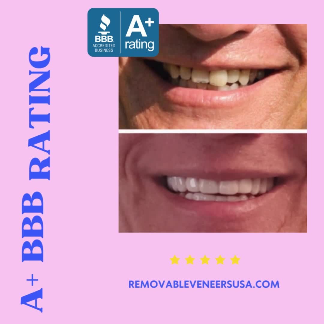 Improve Your Smile with Snap On Veneers - removable-veneers