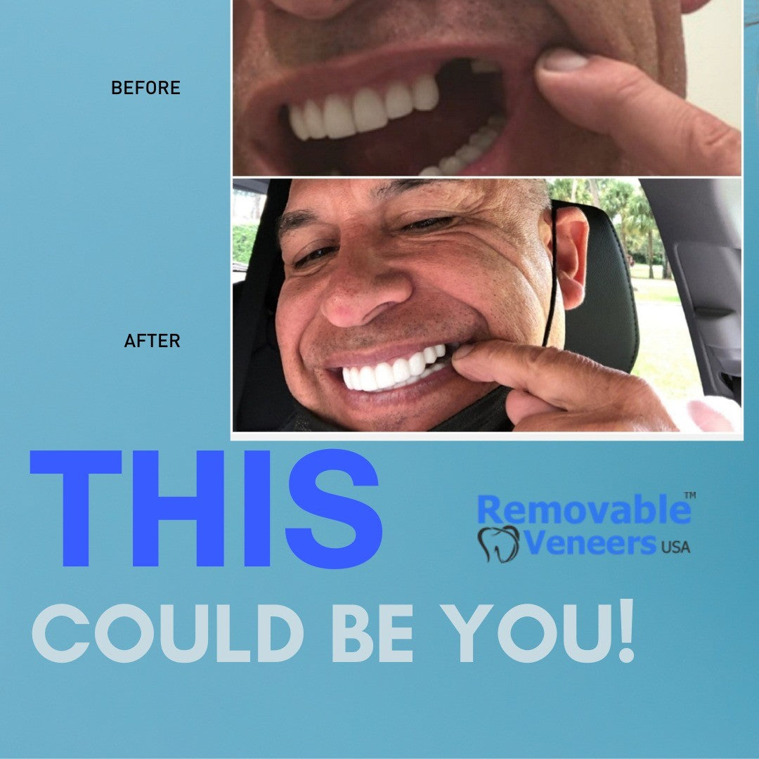 Five Great Things about Using Snap On Veneers - removable-veneers