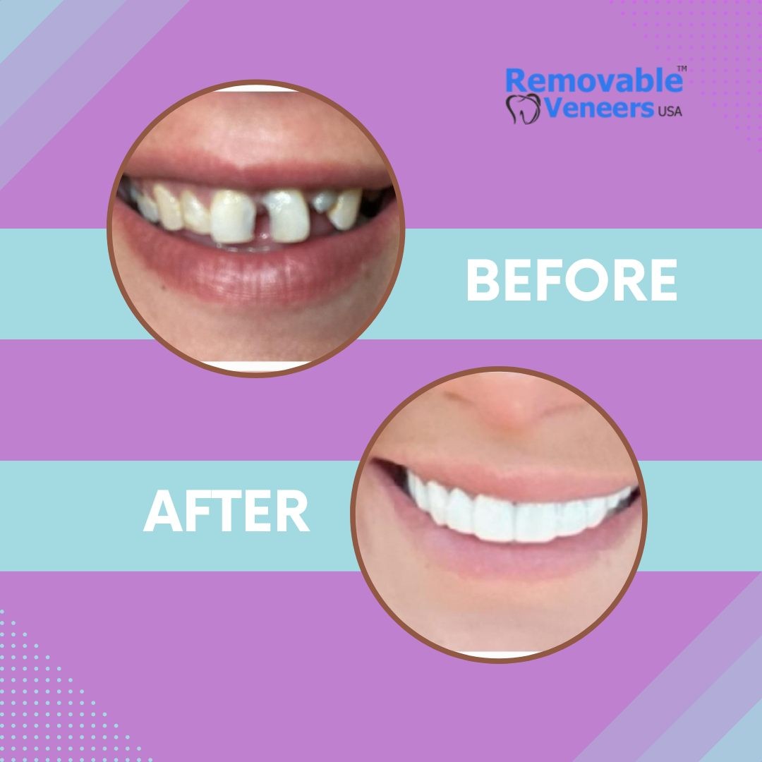 How to Get a Perfect Smile - removable-veneers - clip on veneers - pop on veneers
