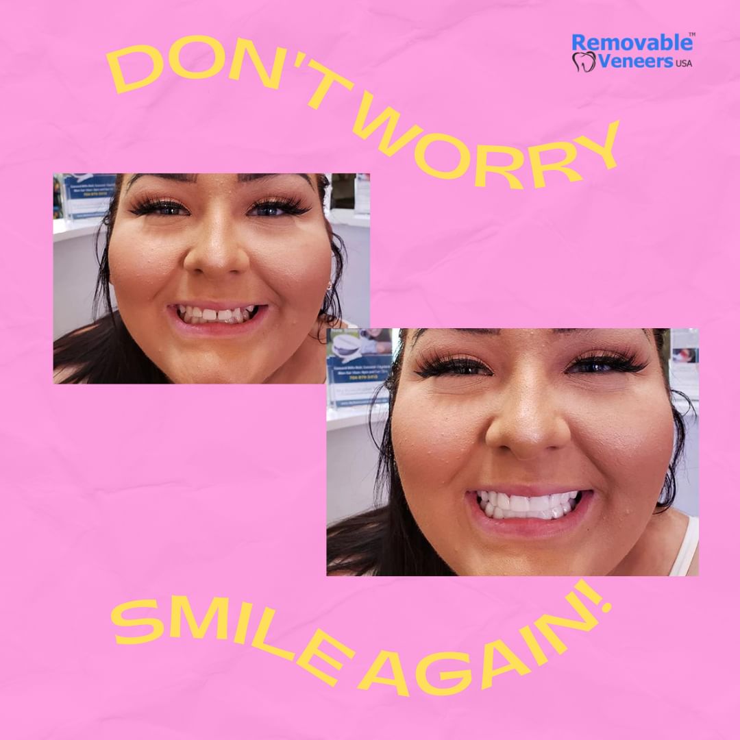 Are There More Affordable Alternatives to Clear Retainers or Braces? Snap On Veneers, A Possible Better Option - removable-veneers