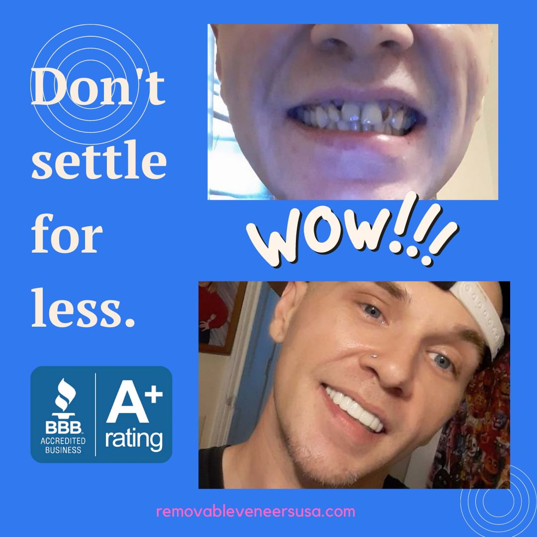 An Alternate Solution to Porcelain Veneers? - removable-veneers
