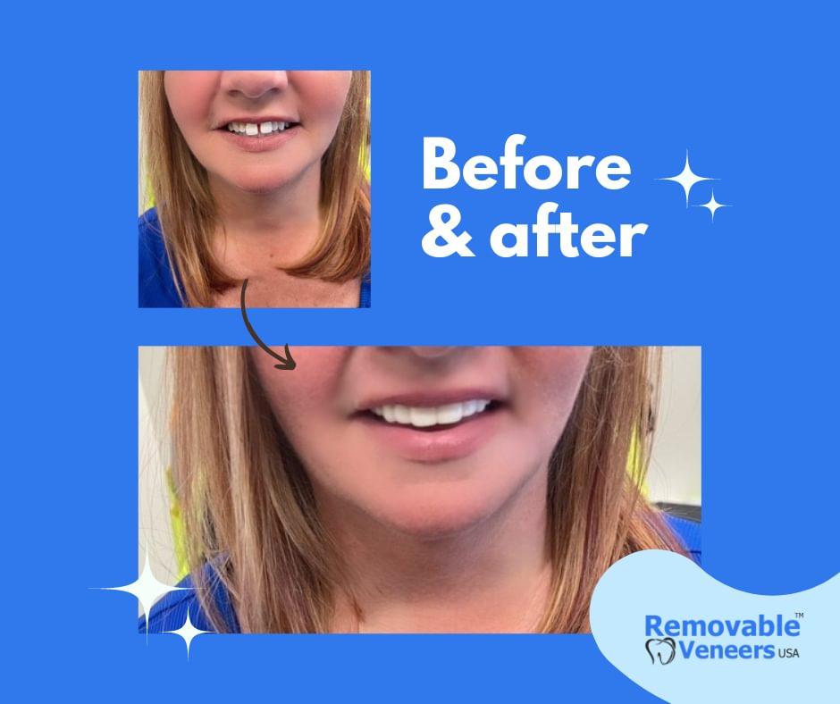 Essential insights before buying Snap-On veneers: 6 key things to consider for a confident smile makeover
