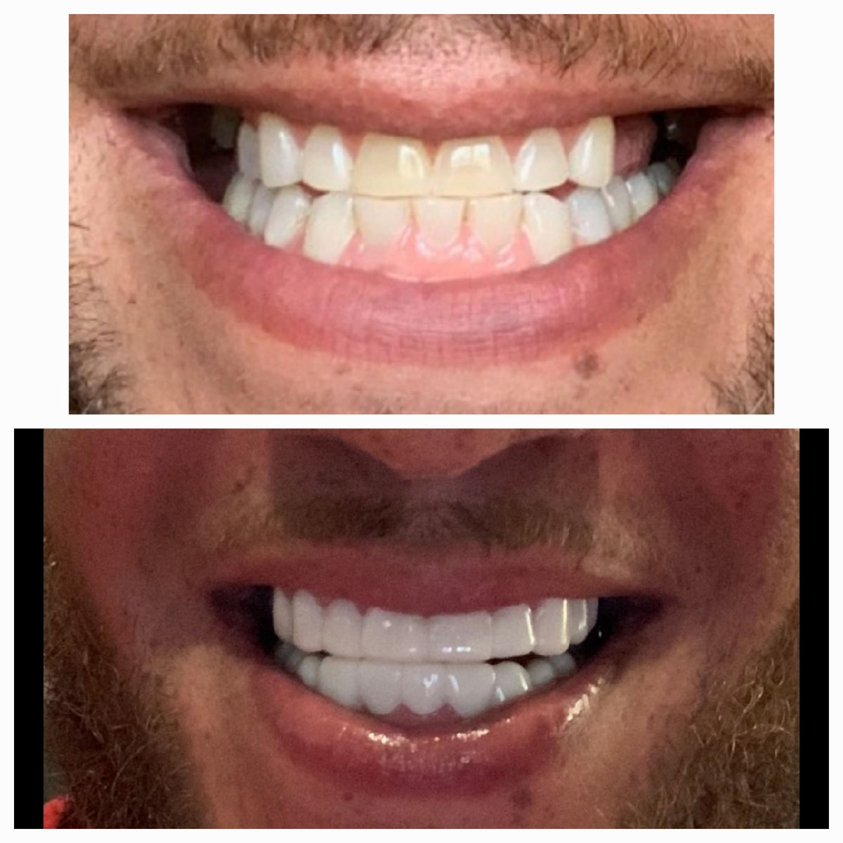 Removable Veneers A Perfect Solution for All Teeth Problems