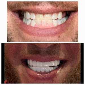 A person smiling confidently, showcasing the versatility of removable veneers as a perfect solution for a variety of teeth problems, such as gaps, chips, stains, and misalignment, without the need for invasive dental procedures