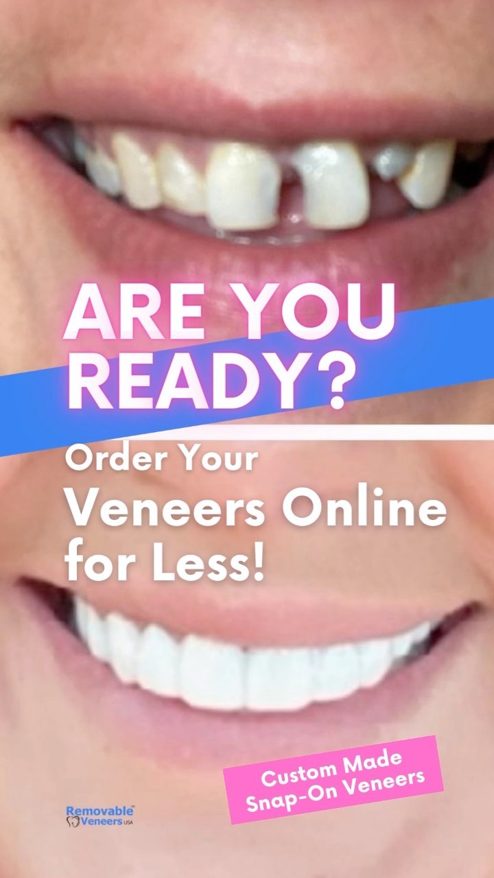 Veneers: All You Need to Know - removable-veneers