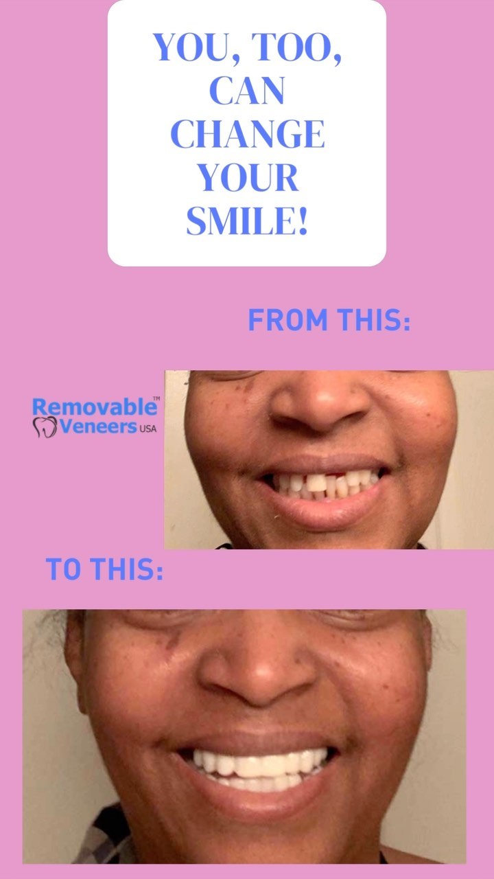 Dental Snap On Veneers Improves Your Smile! - removable-veneers