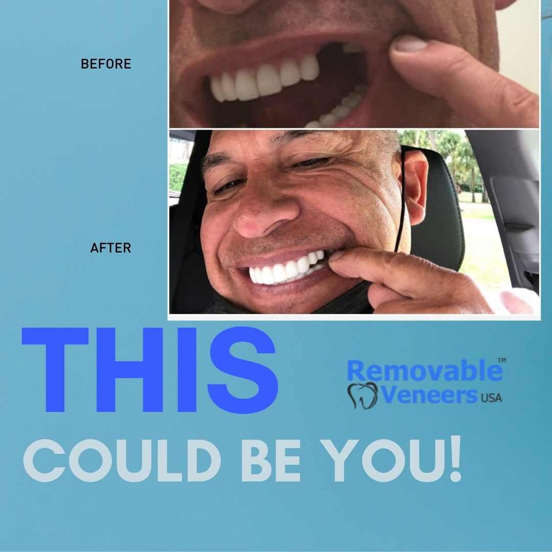 Financing Available for everyone for our Clip On Veneers - removable-veneers