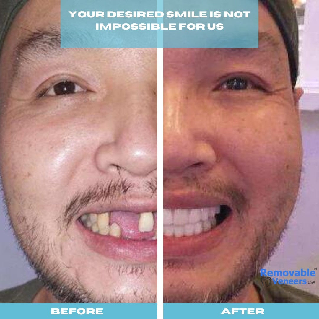 A Brighter Smile Solution - removable-veneers