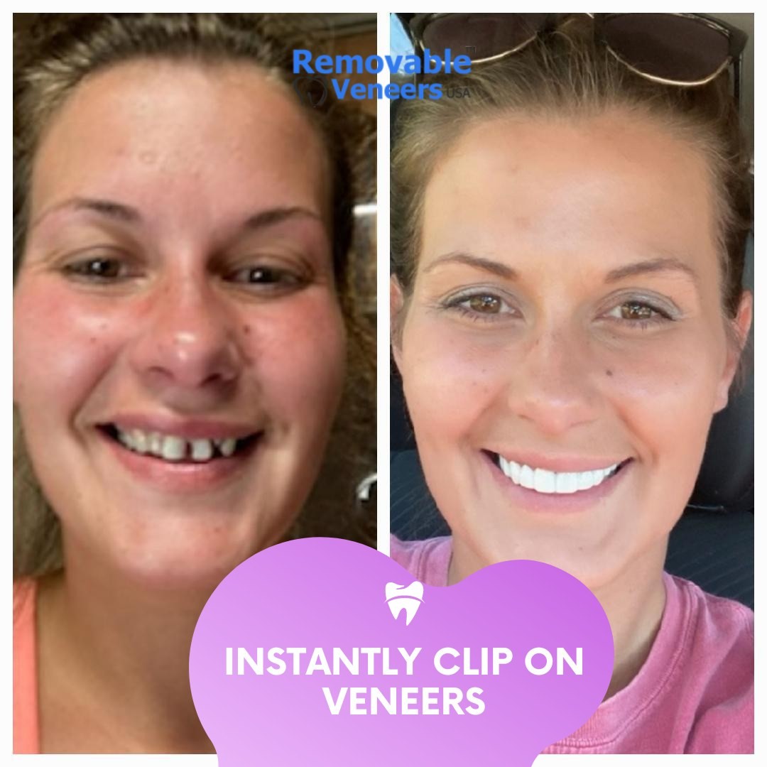 Are Cosmetic Dental Snap On Veneers Right for Me? - removable-veneers
