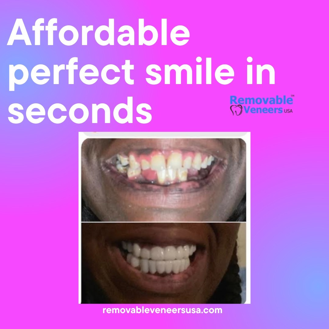 What Are The Benefits Of Snap On Veneers Removable Veneers USA   311937393 810279663724436 2642814030498452911 N 