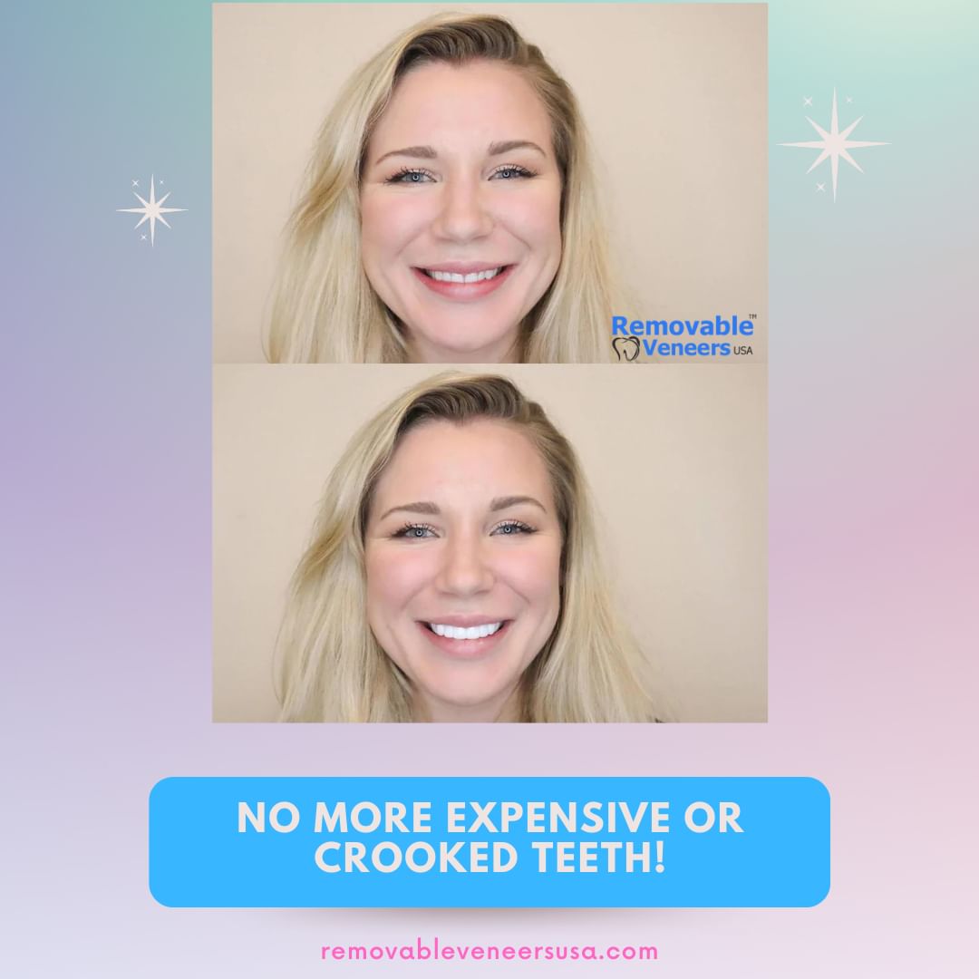 Are You Obsessed with White Teeth? - removable-veneers