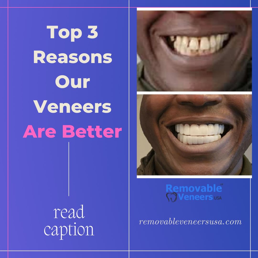 Affordable Alternative to Invisible Braces? - removable-veneers