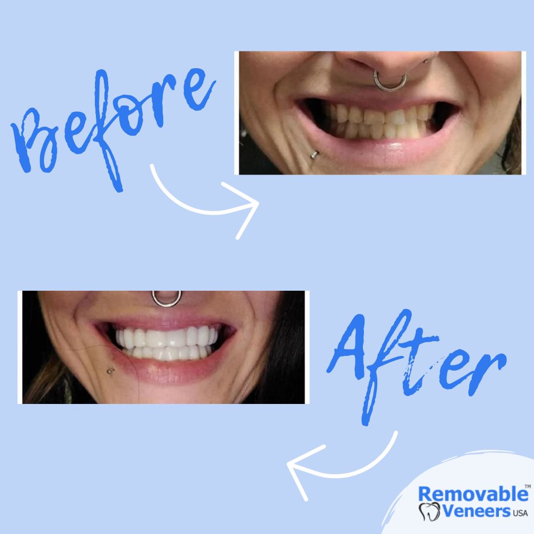 The Perfect Alternative to Cosmetic Dentistry - removable-veneers