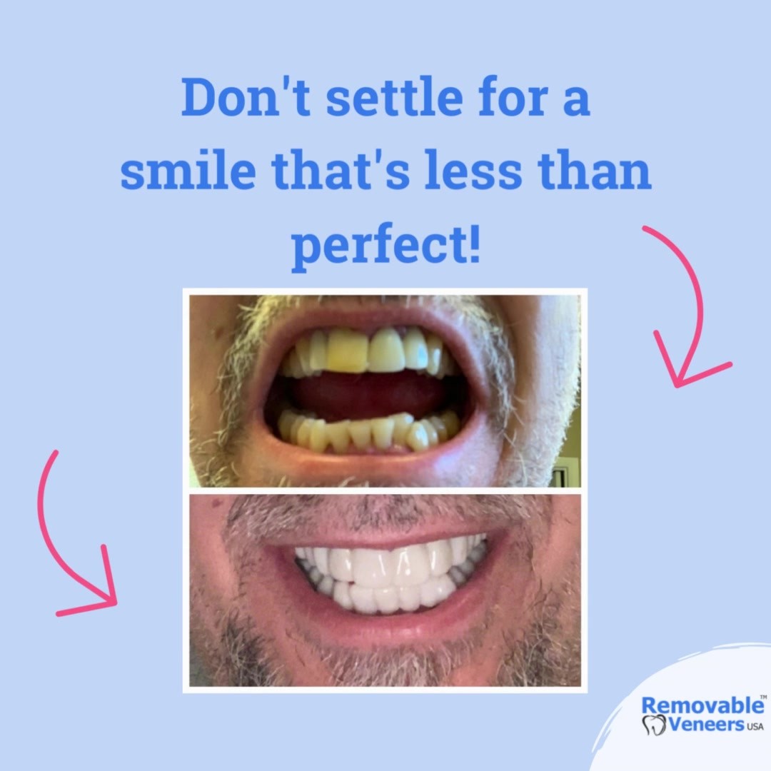 Missing Teeth? We Have an Affordable Solution - removable-veneers