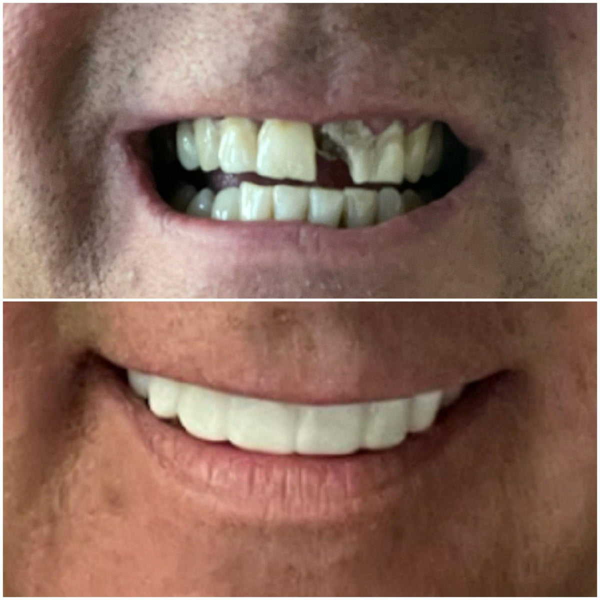 Why Choose Our Clip On Veneers Removable Veneers USA