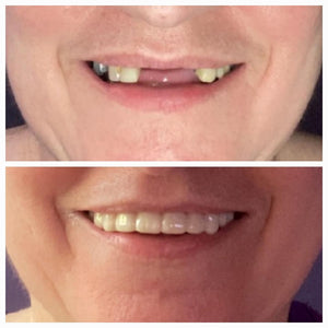 A close-up of a person's smile transformed instantly with removable Snap-On veneers, highlighting their ability to provide a perfect smile in a matter of minutes, without the need for dental appointments or procedures