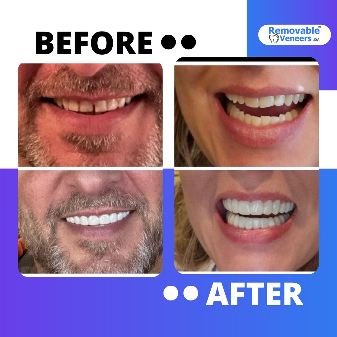 Get the Perfect Smile in an Instant with Natural-Looking Veneers