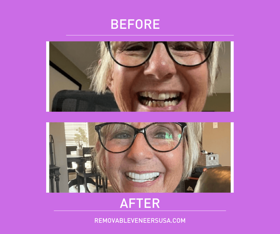 A before-and-after comparison of a person's smile transformed with Snap-On veneers, highlighting their advantages over permanent veneers, such as being less invasive, more affordable, and easily removable
