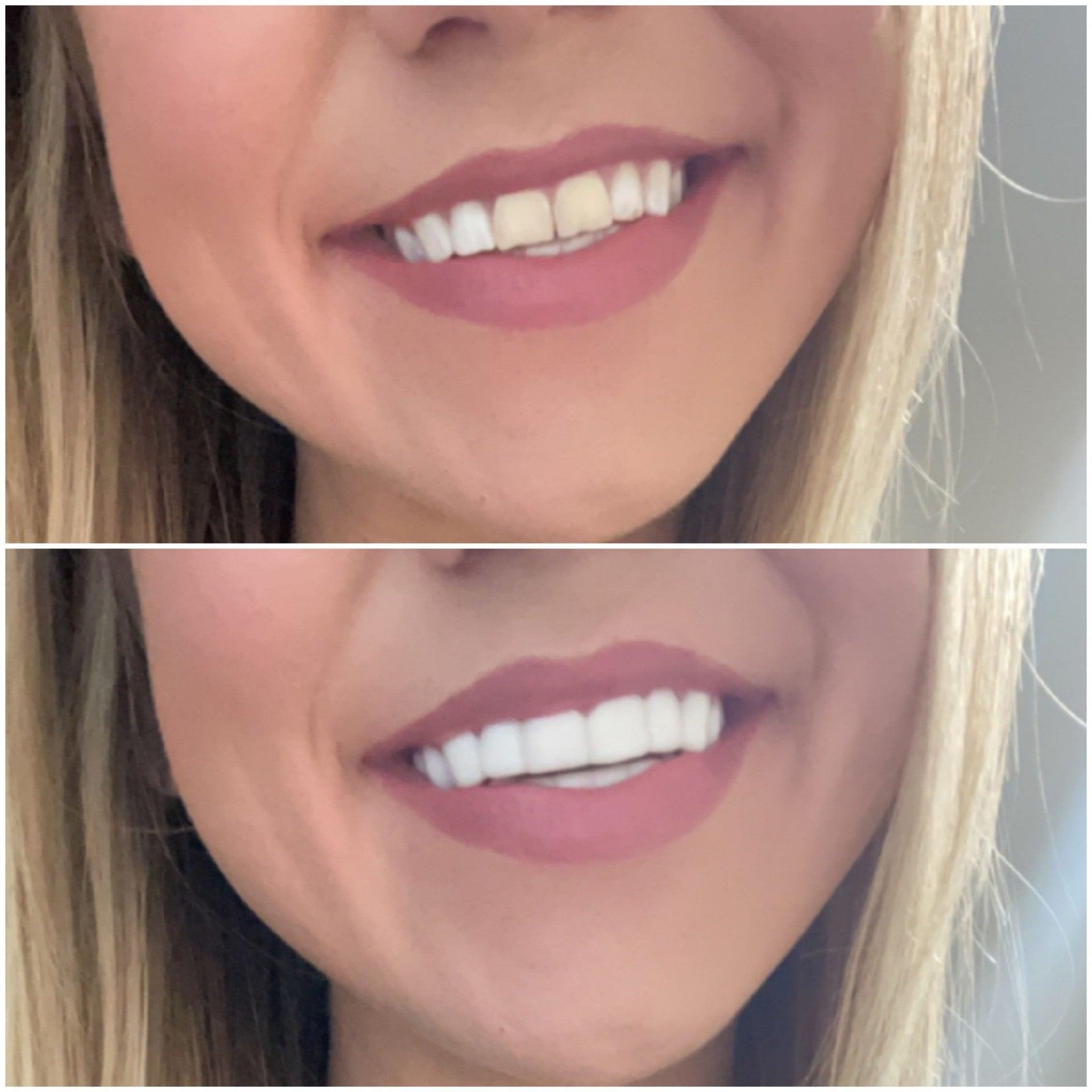 Making the Right Impression - removable-veneers