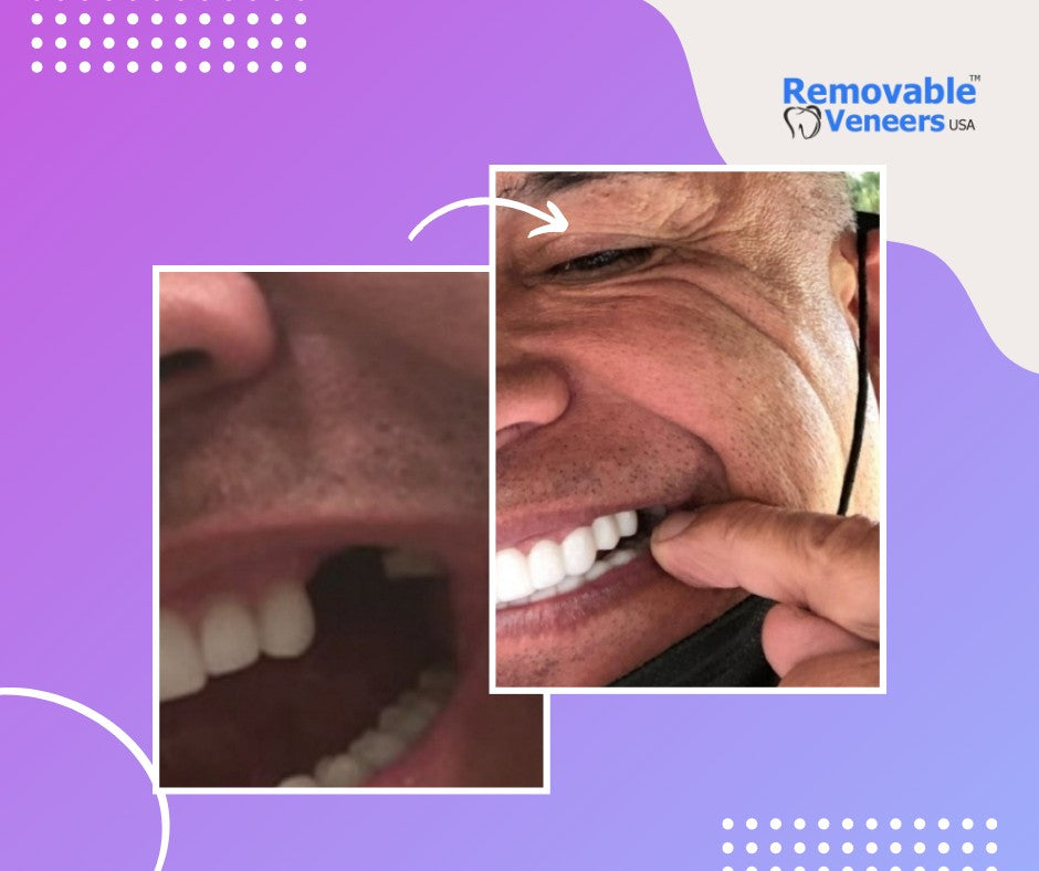 Before and after comparison of a person's smile transformed with removable veneers, showcasing their ability to cover gaps, chips, and stains and improve overall appearance