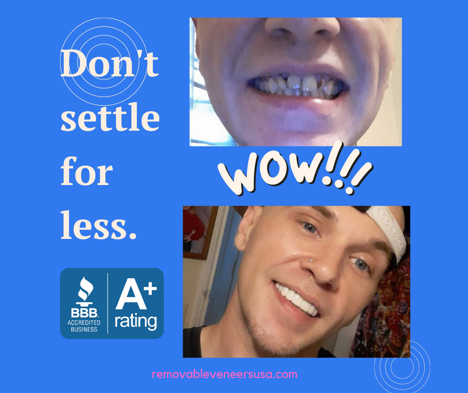 A close-up of a man's smile transformed with custom removable Snap-On veneers, emphasizing their ability to provide a celebrity-grade smile and boost one's overall appearance and confidence