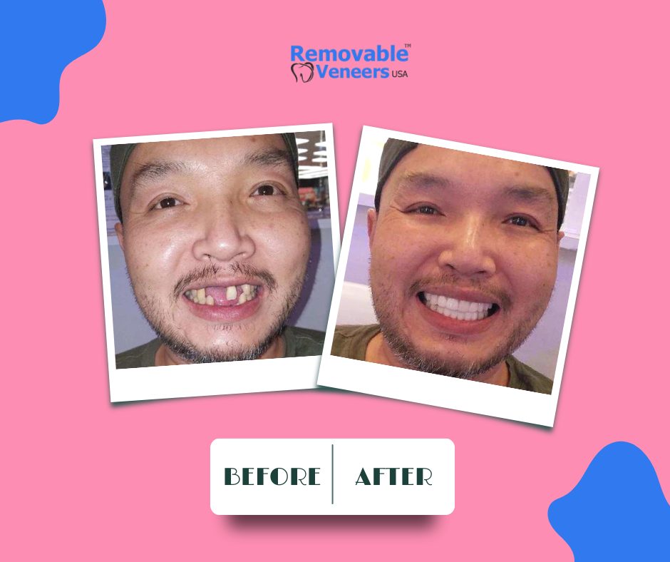 A man smiling confidently, showcasing the potential impact of Snap-On veneers on boosting one's self-esteem and confidence through a transformed smile
