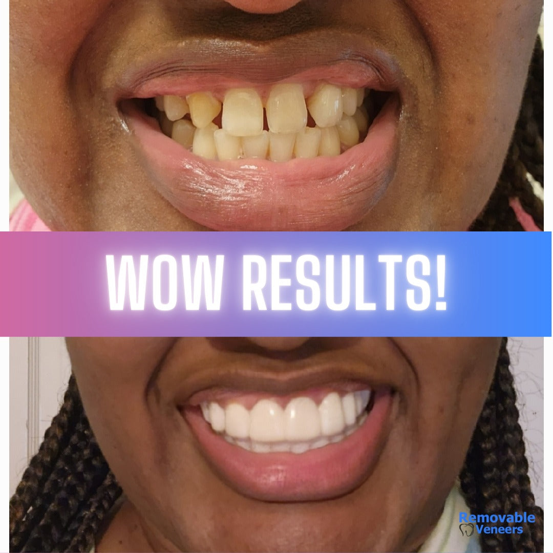A person smiling confidently with clip-on veneers, highlighting their advantages as the best way to improve your smile, such as being affordable, convenient, non-invasive, and customizable to fit over existing teeth seamlessly