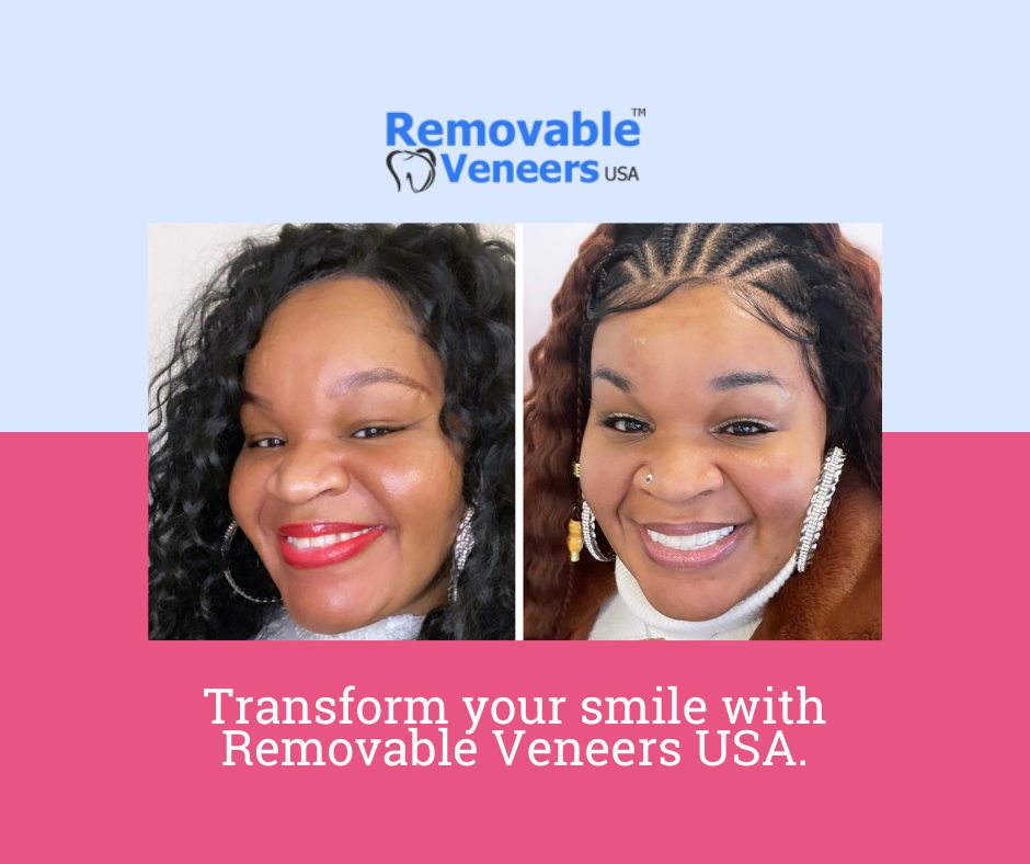 Get a flawless smile with the benefits of clip-on veneers: affordability, convenience, and easy to use