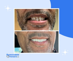 Transform Your Smile: Clip-On Veneers vs. Braces - Which is Right for You