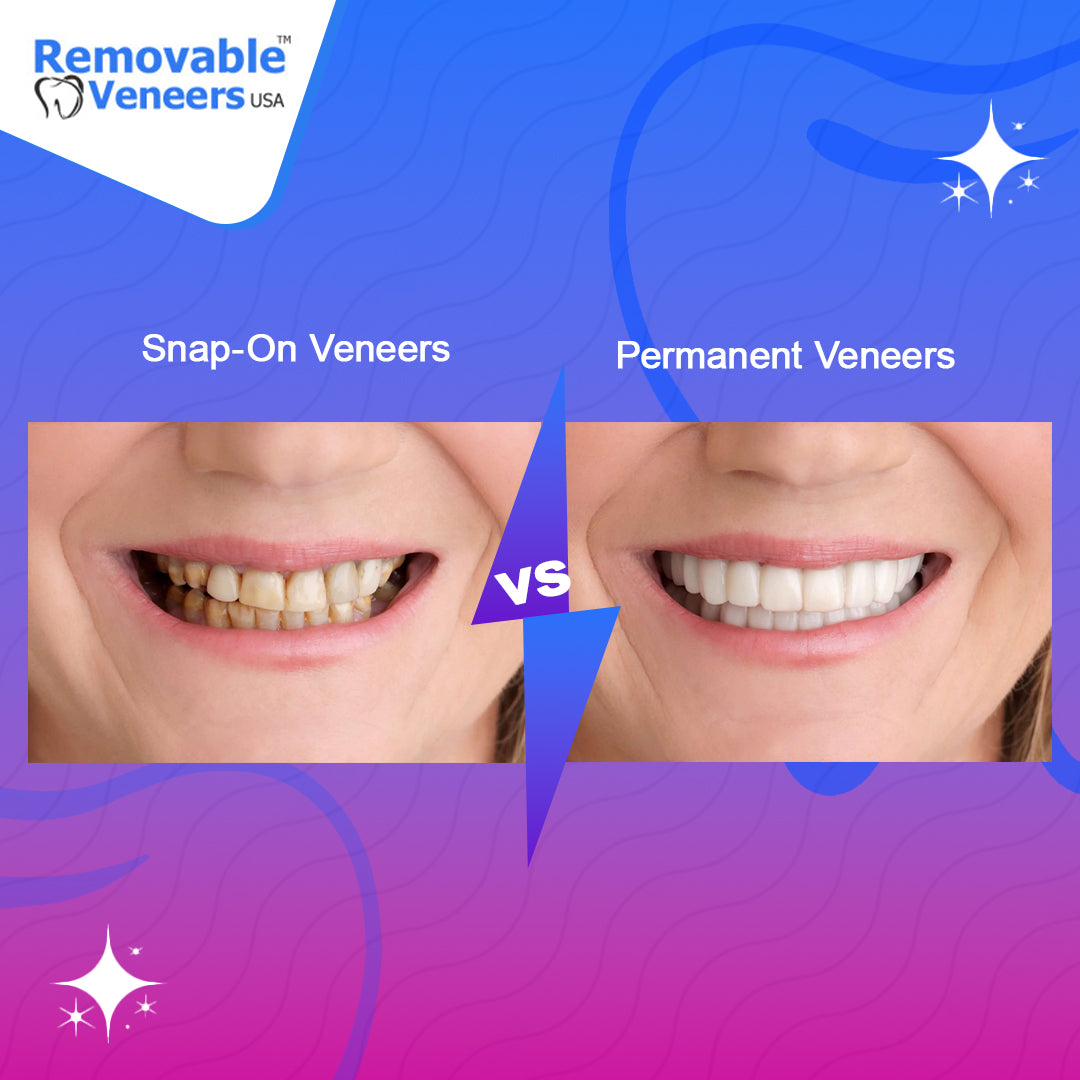 A set of removable veneers before and after image, highlighting their convenience and affordability as a popular solution for achieving a perfect smile in the United States