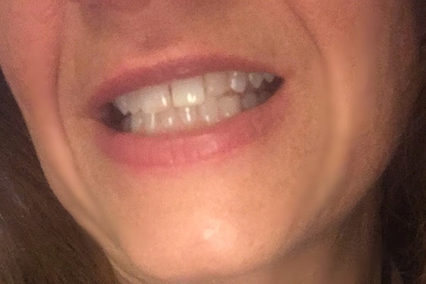 REMOVABLE VENEERS USA - BEFORE - AFTERS