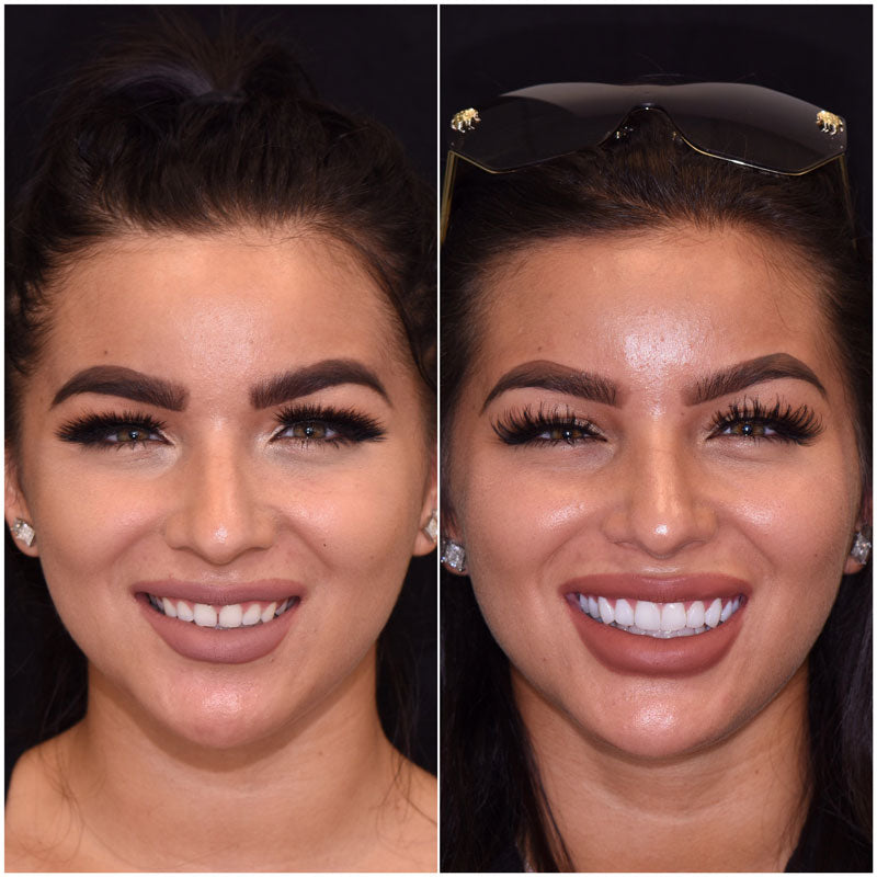 Before and After - Removable Veneers USA 